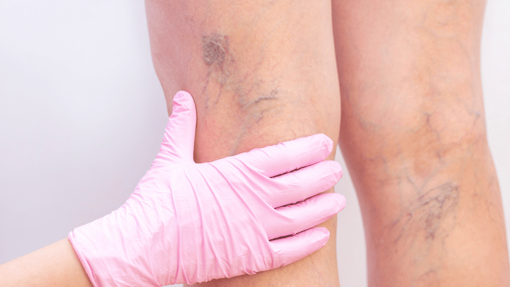 Exploración médica de varices en las piernas en consulta especializada en Madrid