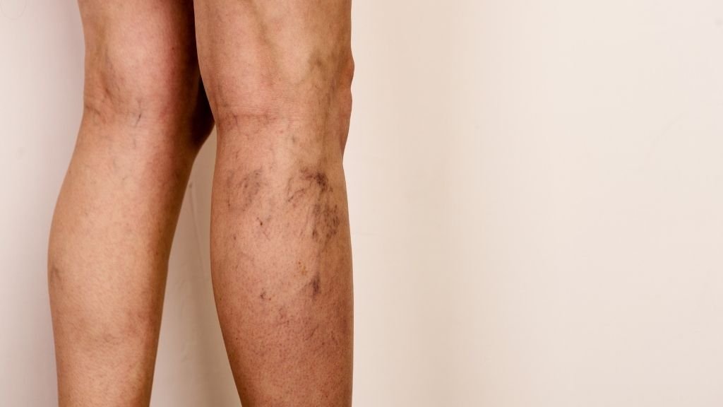 Piernas con arañas vasculares visibles antes de una valoración vascular