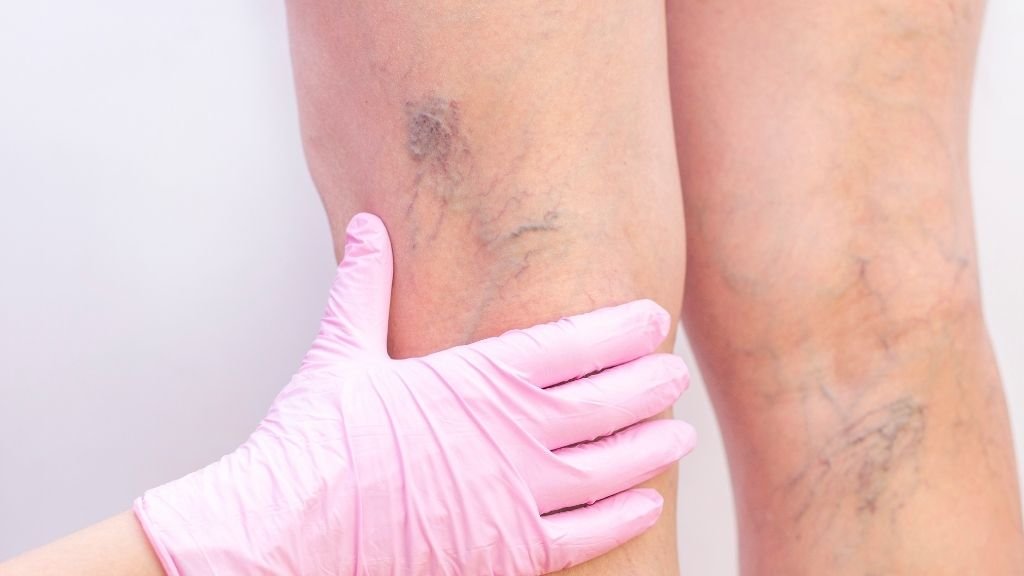 Varices visibles en la pierna, consecuencia del fallo de las válvulas venosas